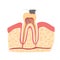 Cartoon Tooth with Stage of Dental Caries Formation. Vector