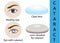 A cataract is an clouding crystalline lens inside the eye.