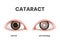 Cataract vector illustration. Healthy eye versus lens clouding