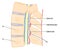 Catheter in epidural space