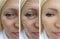 Caucasian facial woman wrinkles removal collagen correction biorevitalization treatment before and after procedures