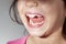 A caucasian girl with teeth crowding is showing the inside of her mouth in a dentist exam room