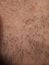 caucasian skin with ingrown hair and man short beard