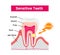 Cause and mechanism of Sensitive teeth illustration