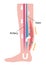 Cause of swelling, edema of the legs. / English