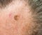 Caused by sun damage by prolonged exposure since youth a lentigo maligna, melanoma in situ on the forehead of a 64 year old man