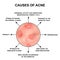 Causes of acne. Pustules, papules, comedones, blackheads, acne on the skin. Infographics. Vector illustration on