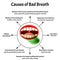 Causes of bad breath. Halitosis. The structure of the teeth and oral cavity. Diseases of the teeth. Infographics. Vector