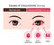Causes of conjunctivitis pink eye vector illustration