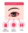 Causes of conjunctivitis pink eye vector illustration