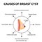 Causes of cyst in the mammary gland. World Breast Cancer Day. Tumor. Vector illustration on isolated background