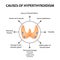The causes of hyperthyroidism of the thyroid gland. Infographics. Vector illustration on background.