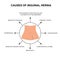 Causes of inguinal hernia. Infographics. Vector illustration on isolated background.