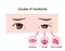 Causes of myokymia eyelid twitch or tic vector illustration