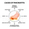 Causes of pancreatitis. The structure of the stomach and pancreas. Infographics. Vector illustration on isolated