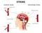 causes of stroke and the development of the disease