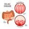 Celiac disease. small intestinal with normal villi, and villous