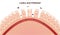 Celiac disease Small intestine lining damage. good and damaged villi . leaky gut progression