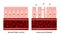 Celiac disease Small intestine lining damage. good and damaged villi . leaky gut progression