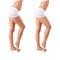 Before and after, cellulite concept