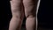 Cellulite male legs with stretch marks, hormonal disorder, skin care, diet