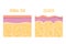 Cellulite skin and healthy skin anatomy. Fat tissue of human body