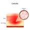 Cellulitis. layers of the human Skin. Close-up of Staphylococcus aureus