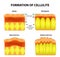 Cellulitis and skin aging in men and women. Infographics. Vector illustration on background