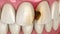 Central incisor teeth damaged by caries. Medically accurate tooth animation
