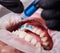 Ceramic braces installation process