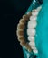 Ceramic front crowns, green background. 8 units dental veneers