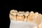 Ceramic tooth crowns and metal pins close-up macro. Orthopedic dentistry restoration of decayed teeth