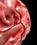Cerebral aneurysm, brain head
