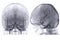 Cerebral angiography  image from Fluoroscopy in intervention radiology  showing cerebral artery