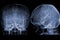 Cerebral angiography  image from Fluoroscopy in intervention radiology  showing cerebral artery