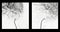 Cerebral angiography  image from Fluoroscopy in intervention radiology  showing cerebral artery