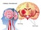 Cerebral hemorrhage