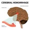 Cerebral hemorrhage