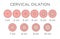 Cervial Dilation Medical Illustration - chart in centimeters