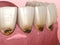 Cervical caries on frontal teeth. Medically accurate tooth 3D illustration