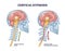 Cervical kyphosis condition with spine and neck curvature outline diagram