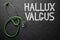 Chalkboard with Hallux Valgus. 3D Illustration.