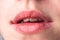 Chapped, or cracked, dry lips that have lost moisture. Woman maintains her lips.