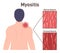 Character having neck and shoulder pain. Trigger point in muscle cause