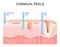 Chemical peels. Exfoliation