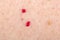 Cherry angioma on human skin