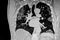 Chest CT Scan of Novel Coronavirus COVID-19
