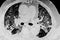 Chest CT Scan of Novel Coronavirus COVID-19