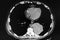 Chest CT Scan of patient with Squamous Cell Carcinoma