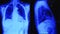 Chest ct xray scan film illuminated by blue light